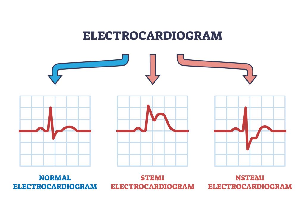 Anatomical diagram comparing different types of myocardial infarction and their effect on the heart wall.