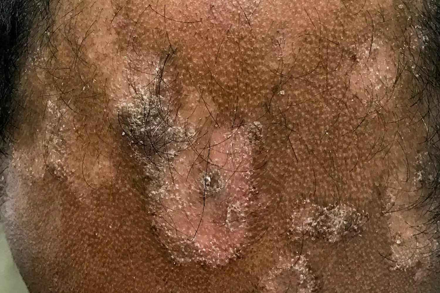 A medical photograph showing scalp psoriasis.