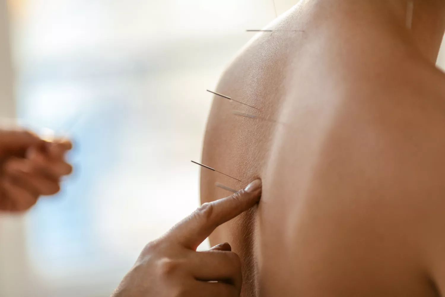 A woman receiving acupuncture as part of a therapeutic wellness session.