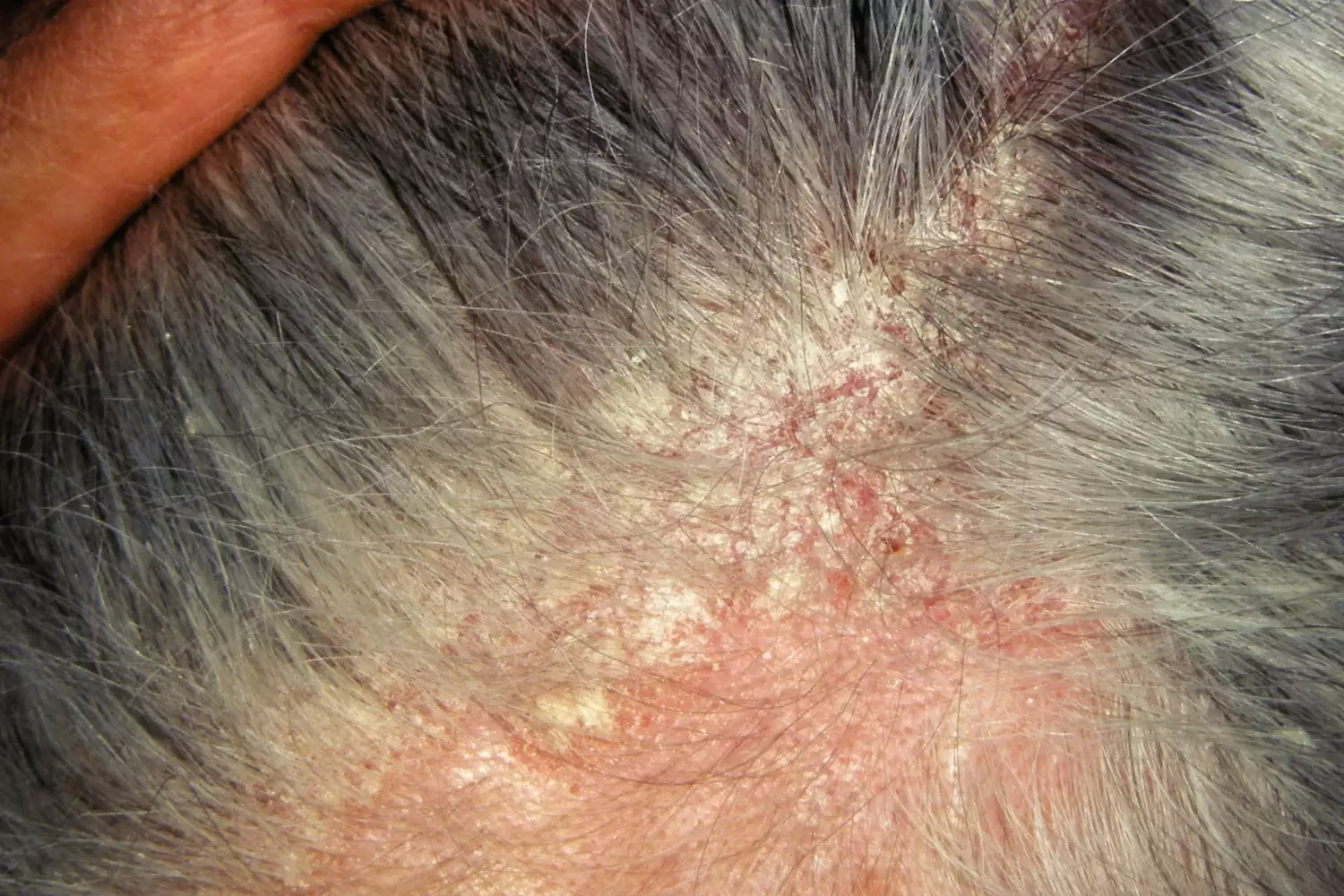 High-detail image of seborrheic eczema on the scalp.