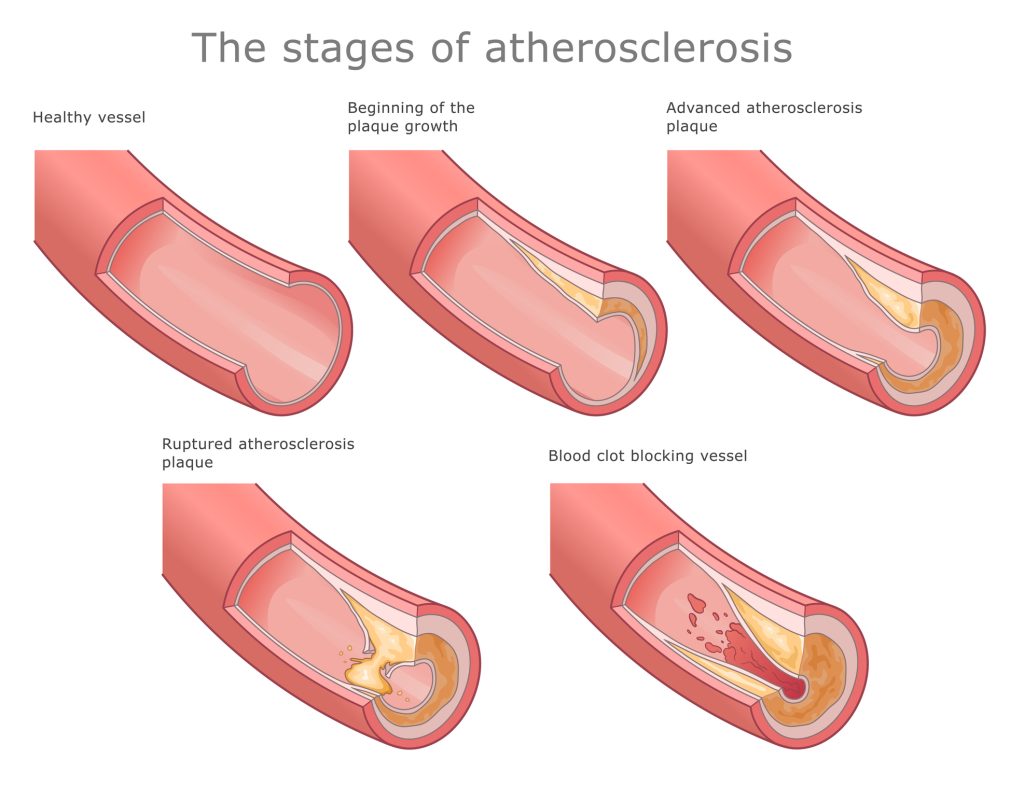 Medical illustration of a coronary artery showing plaque buildup and a blood clot forming.