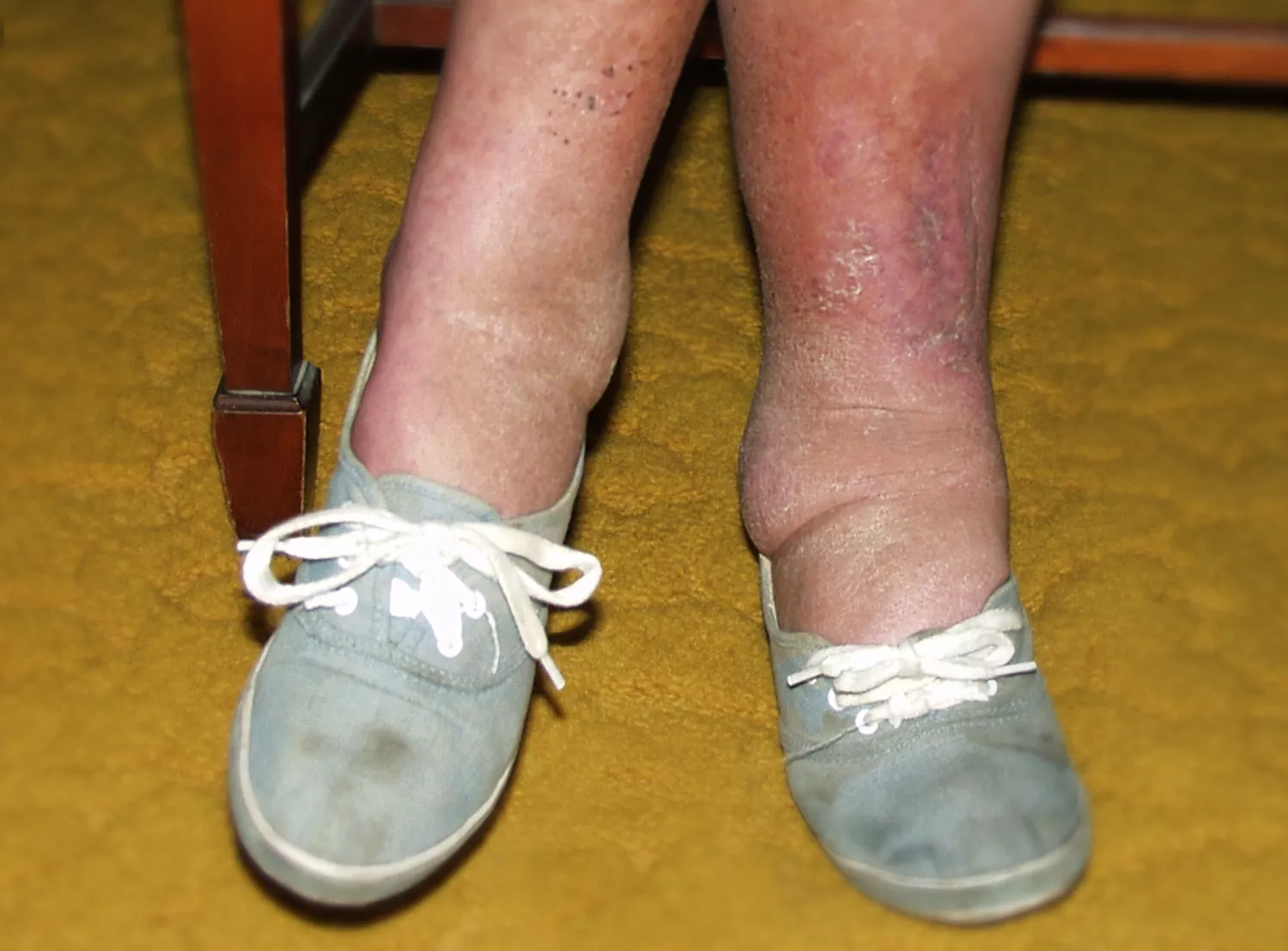 Close-up of a person's swollen ankles and feet indicating edema.