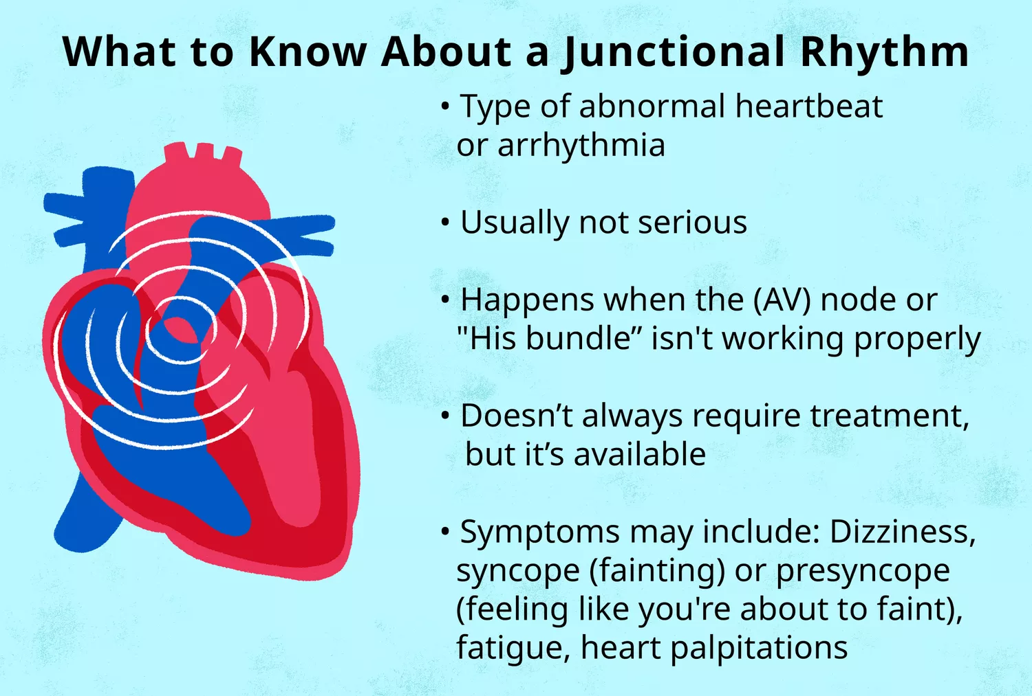 Infographic illustration detailing the key facts and characteristics of a junctional heart rhythm.