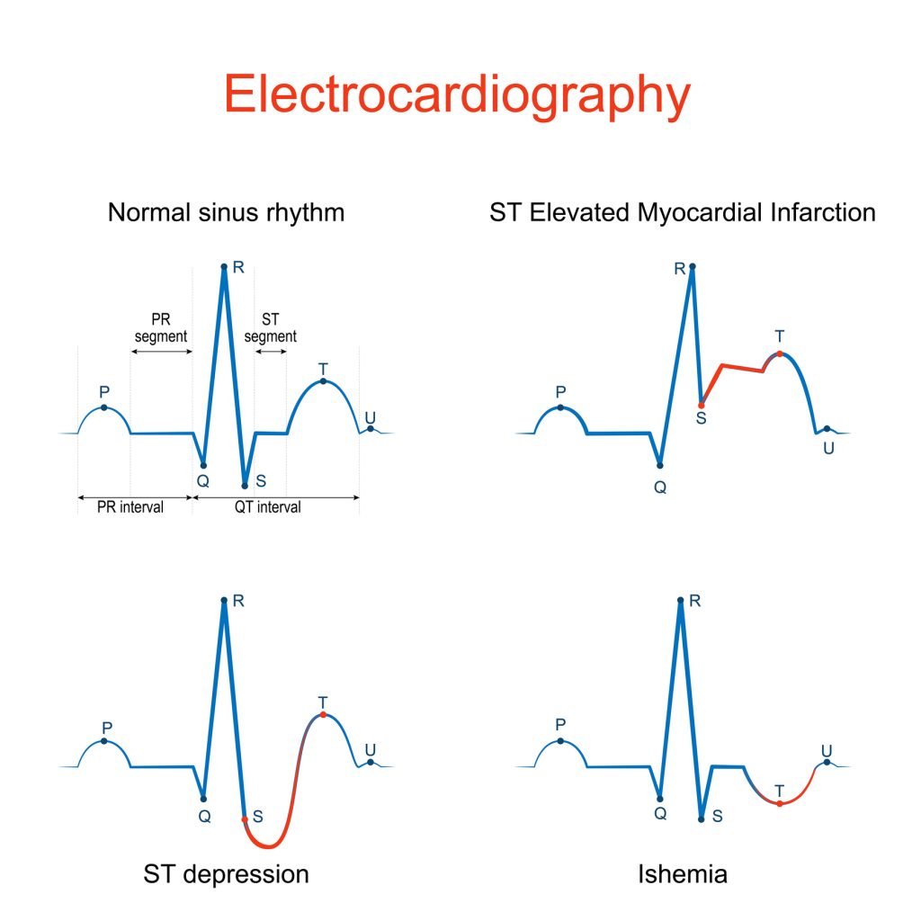 An electrocardiogram monitor displaying a patient's heart rhythm in a clinical setting.