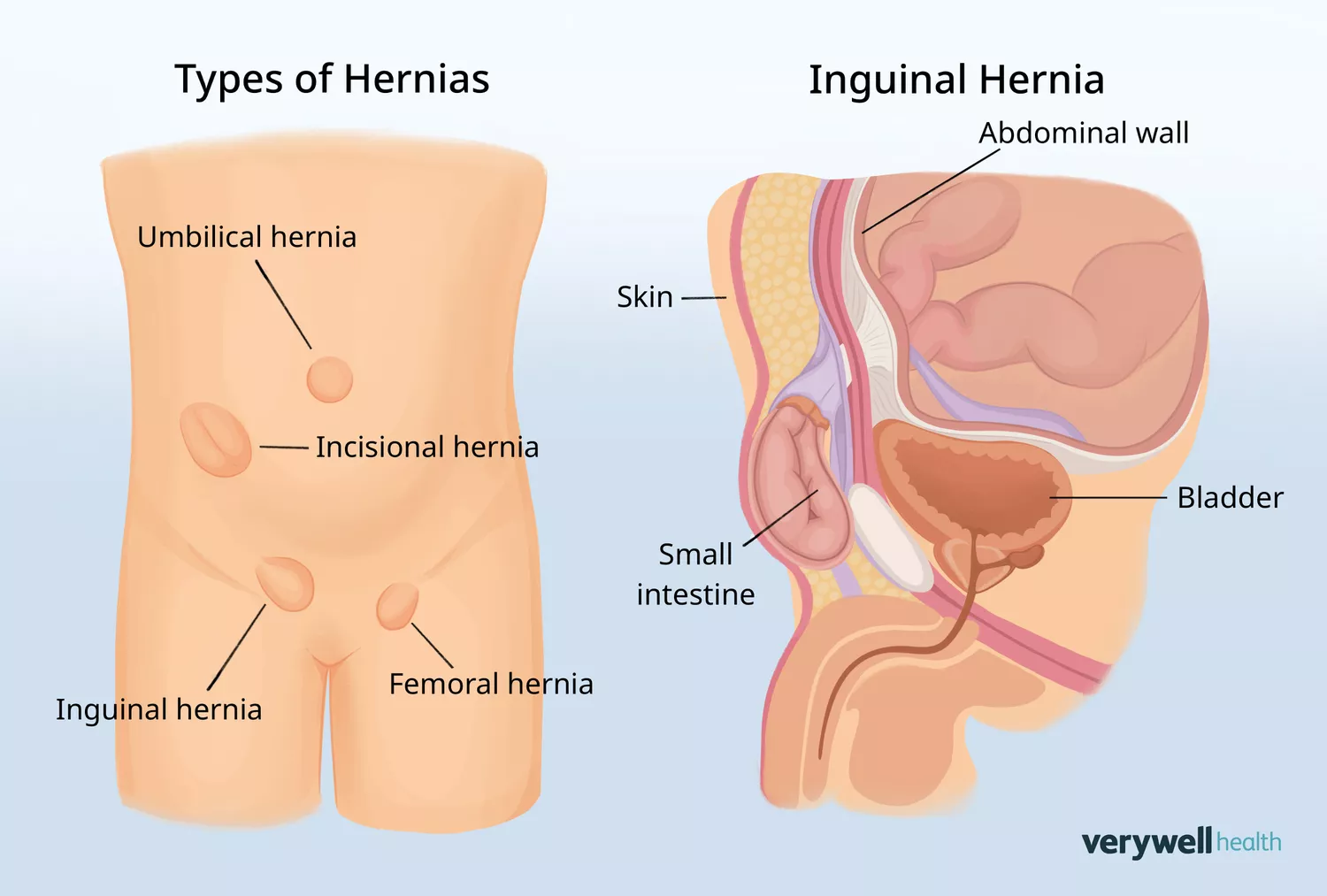 Anatomical illustration showing the visual appearance and location of different types of hernias in the abdominal and groin areas.
