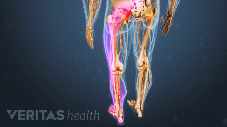 Sciatica Symptoms vs. Muscle Strain: How to Tell