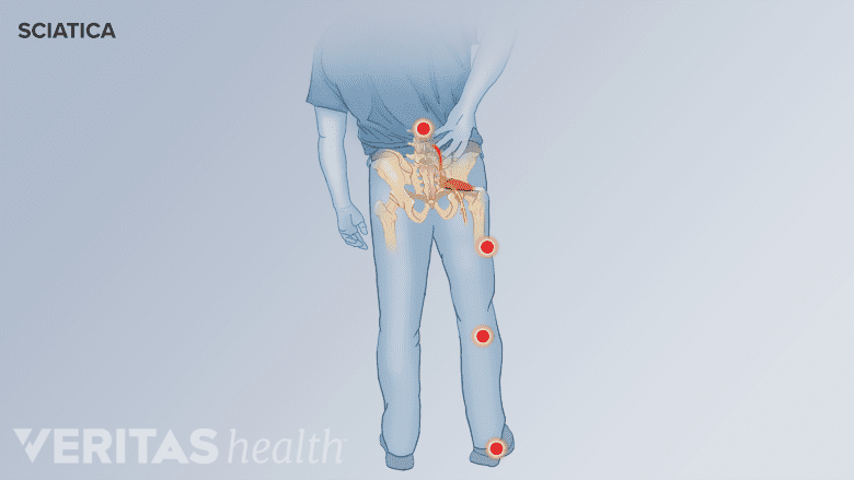 Anatomical map showing the typical pain distribution areas for the sciatic nerve including the lower back, buttocks, and calf.