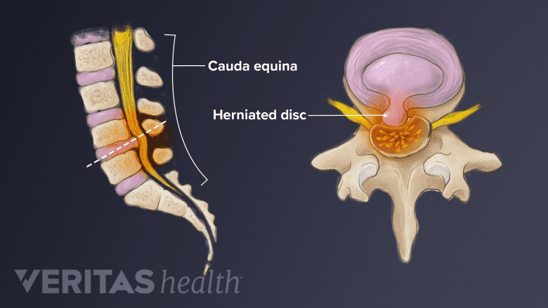 Diagram showing a herniated disc causing severe compression of the cauda equina nerve roots.