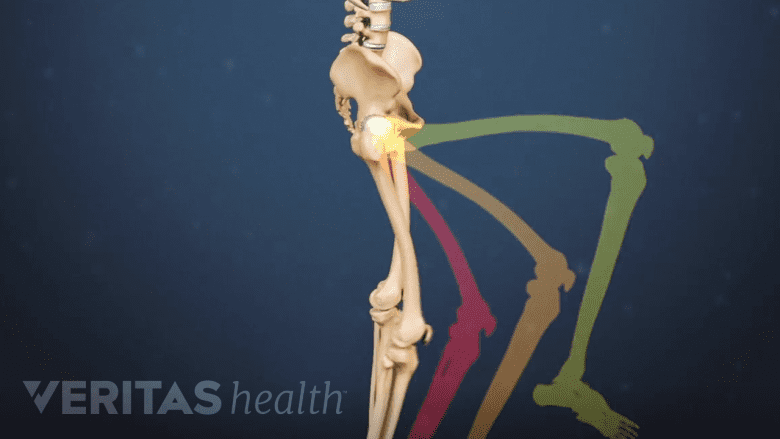 Illustration depicting a person experiencing leg weakness and sensory changes in the lower extremity.