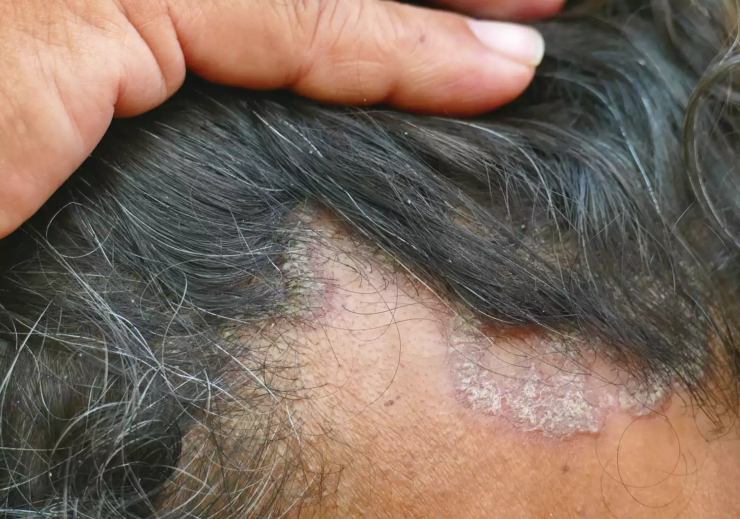 Dry, flaky skin patches on a human scalp.