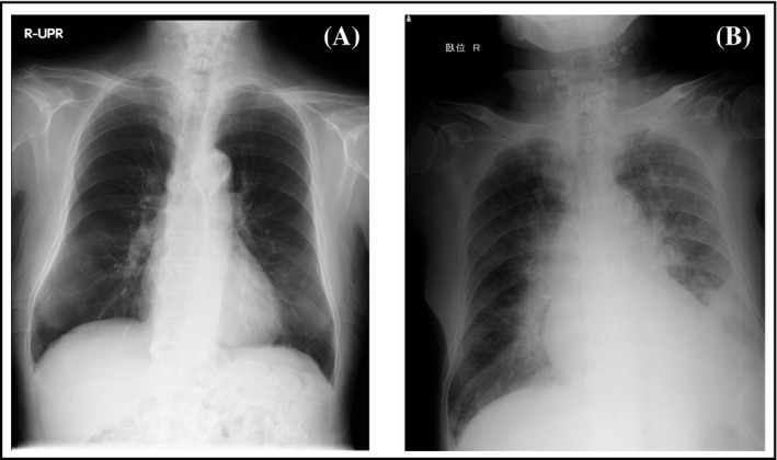 Side-by-side chest X-rays showing the development of pulmonary edema in a patient following the physical strain of defecation.