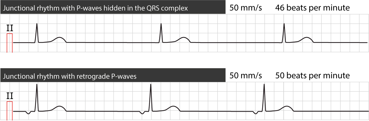 Junctional Rhythm: Causes, Symptoms, and ECG Criteria