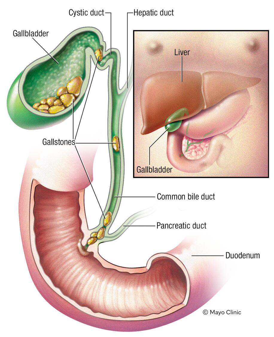 Gallstone Causes: Role of Bile and Cholesterol